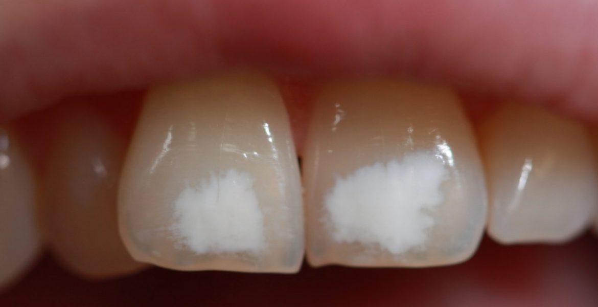 Fluorosis dental: más que simples manchas - Más que Dientes